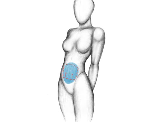 tummy tuck