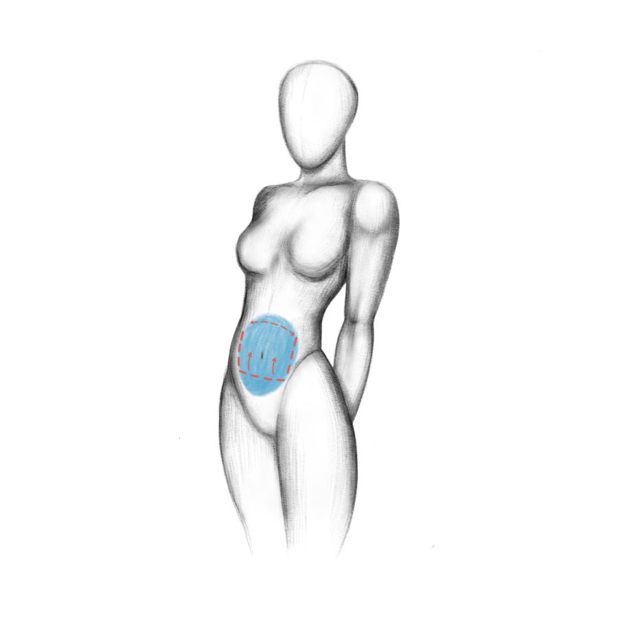 tummy tuck