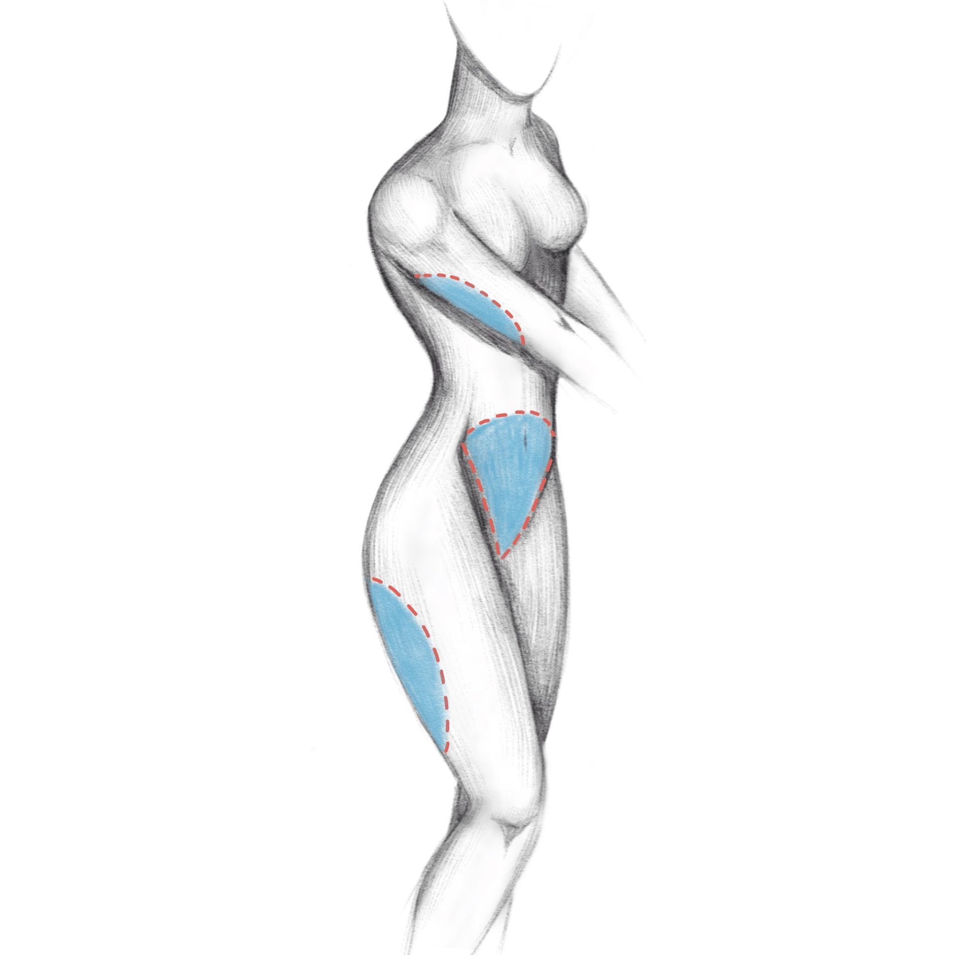 liposuction