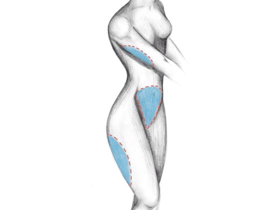 liposuction