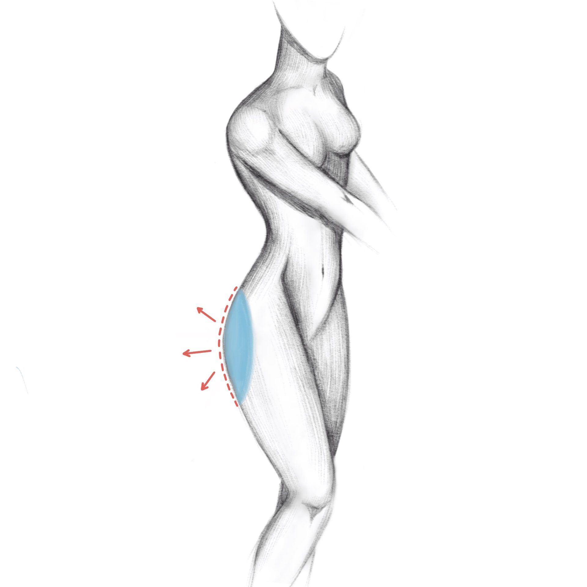 buttocks enlargement