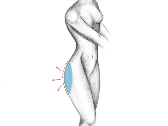 buttocks enlargement