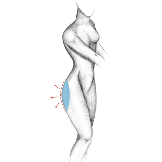 buttocks enlargement