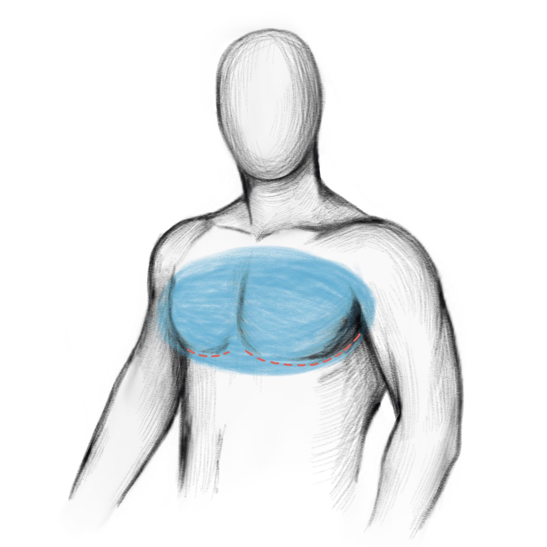 gynecomastia abroad