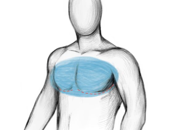 gynecomastia abroad