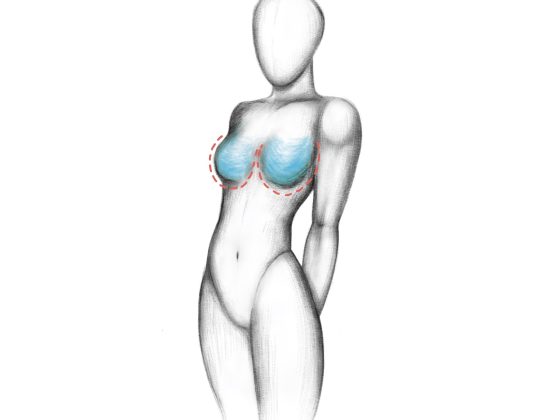 breast enlargement