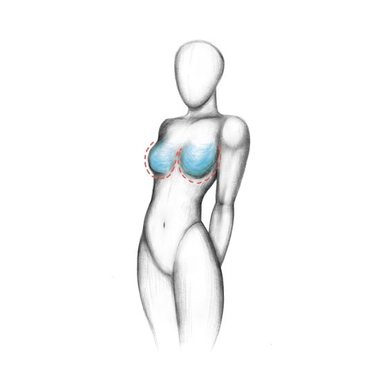 breast enlargement