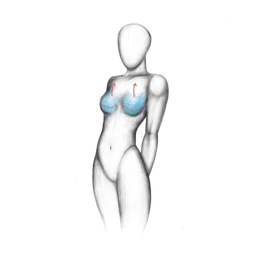 breast lift