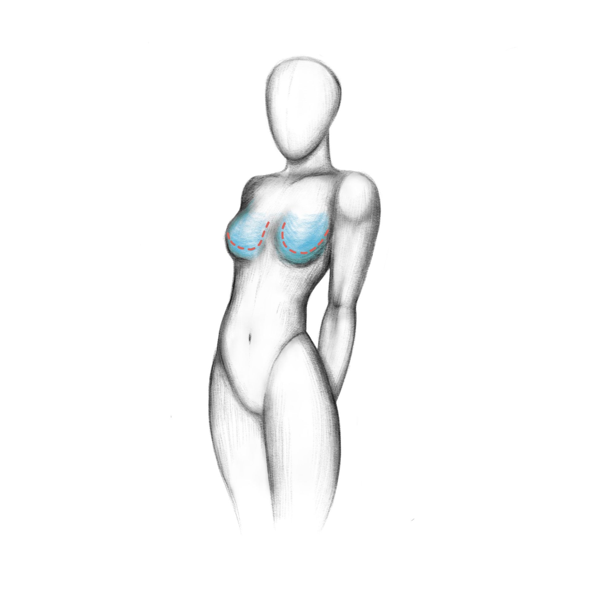 Breast reduction