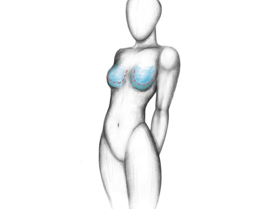 Breast reduction